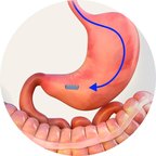 A small magnet travelling down into the stomach