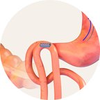 The two magnets holding together through the gut wall
